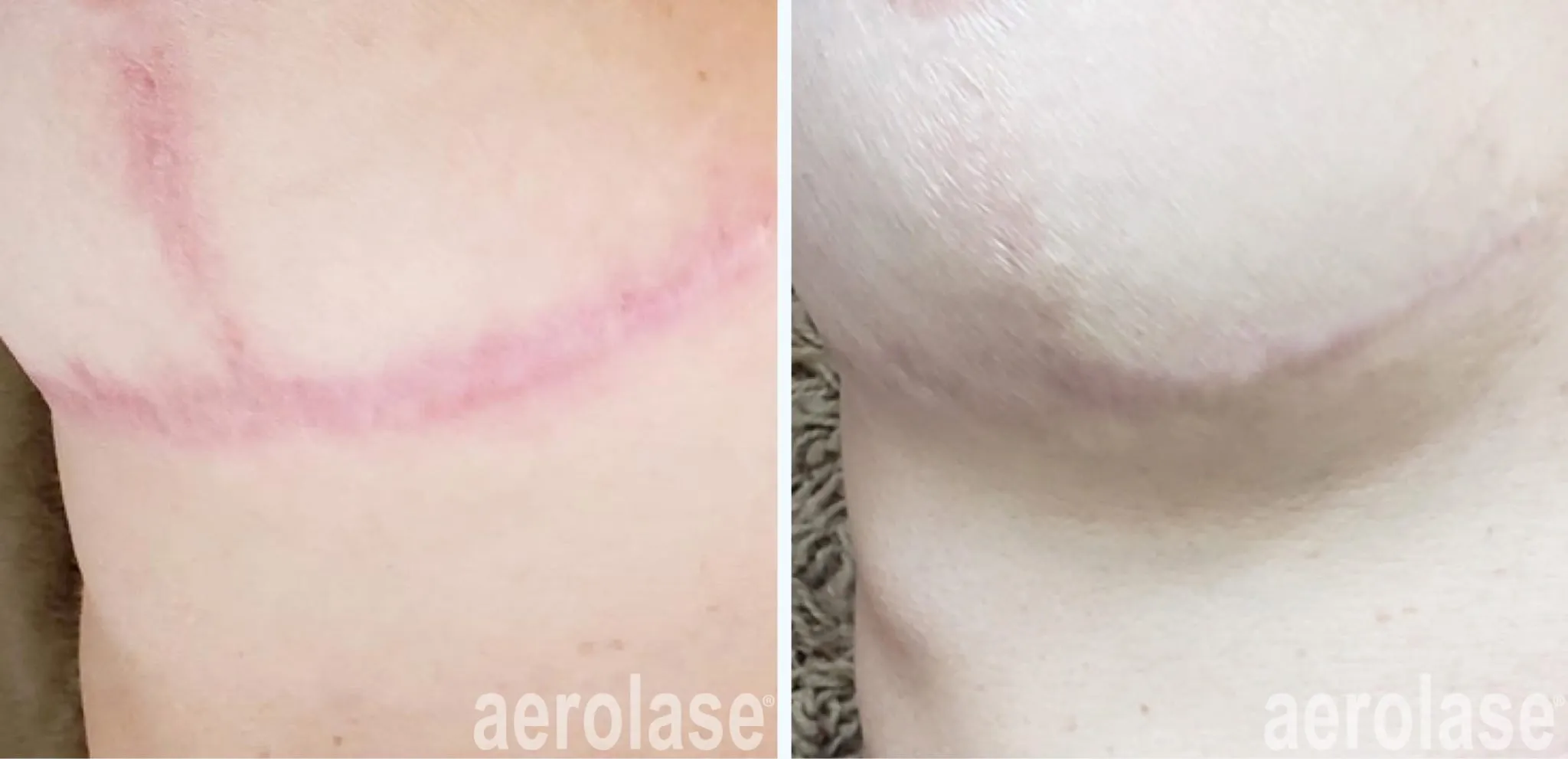 111post-surgical-scar-2-before-and-after-2048x991
