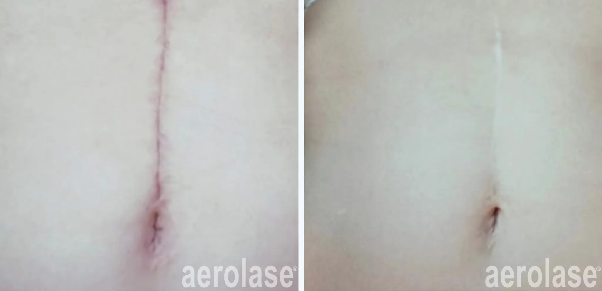 111post-surgical-scar-before-and-after-2048x991