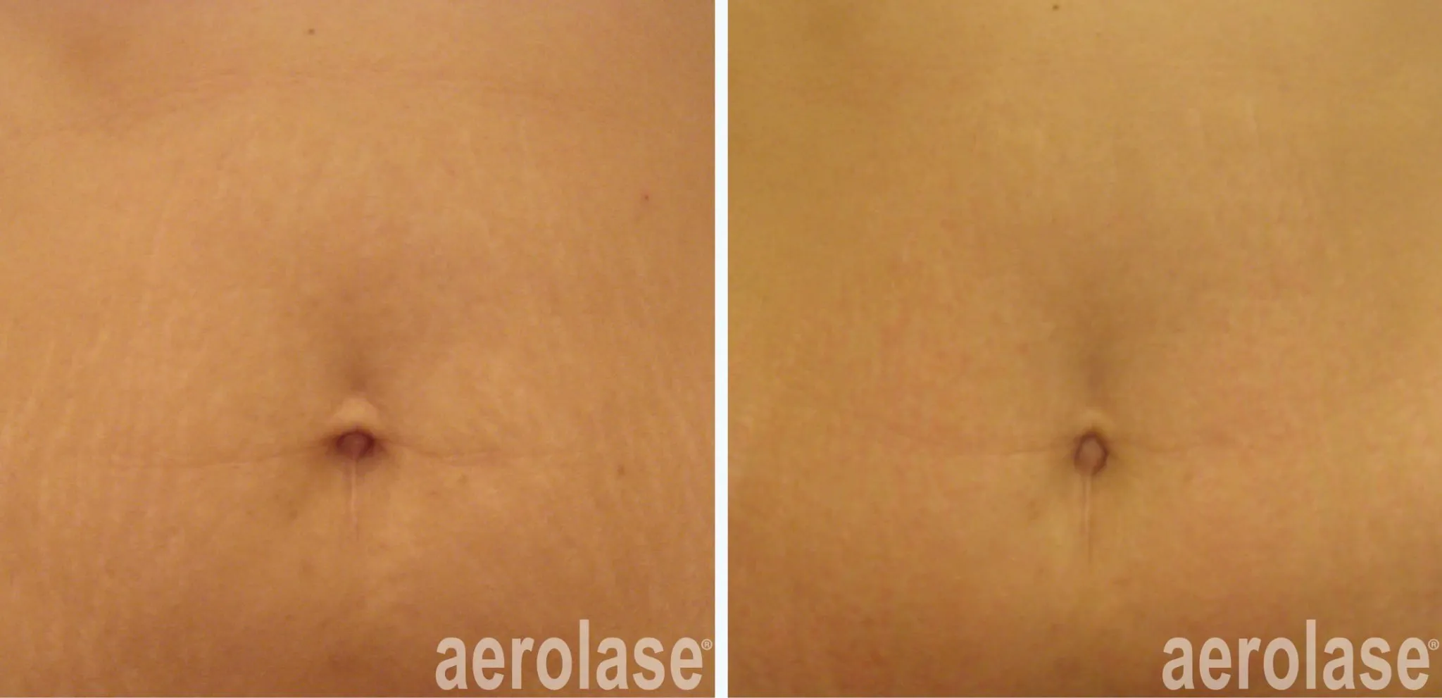 111striae-viktor-moiseev-before-and-after-2048x991