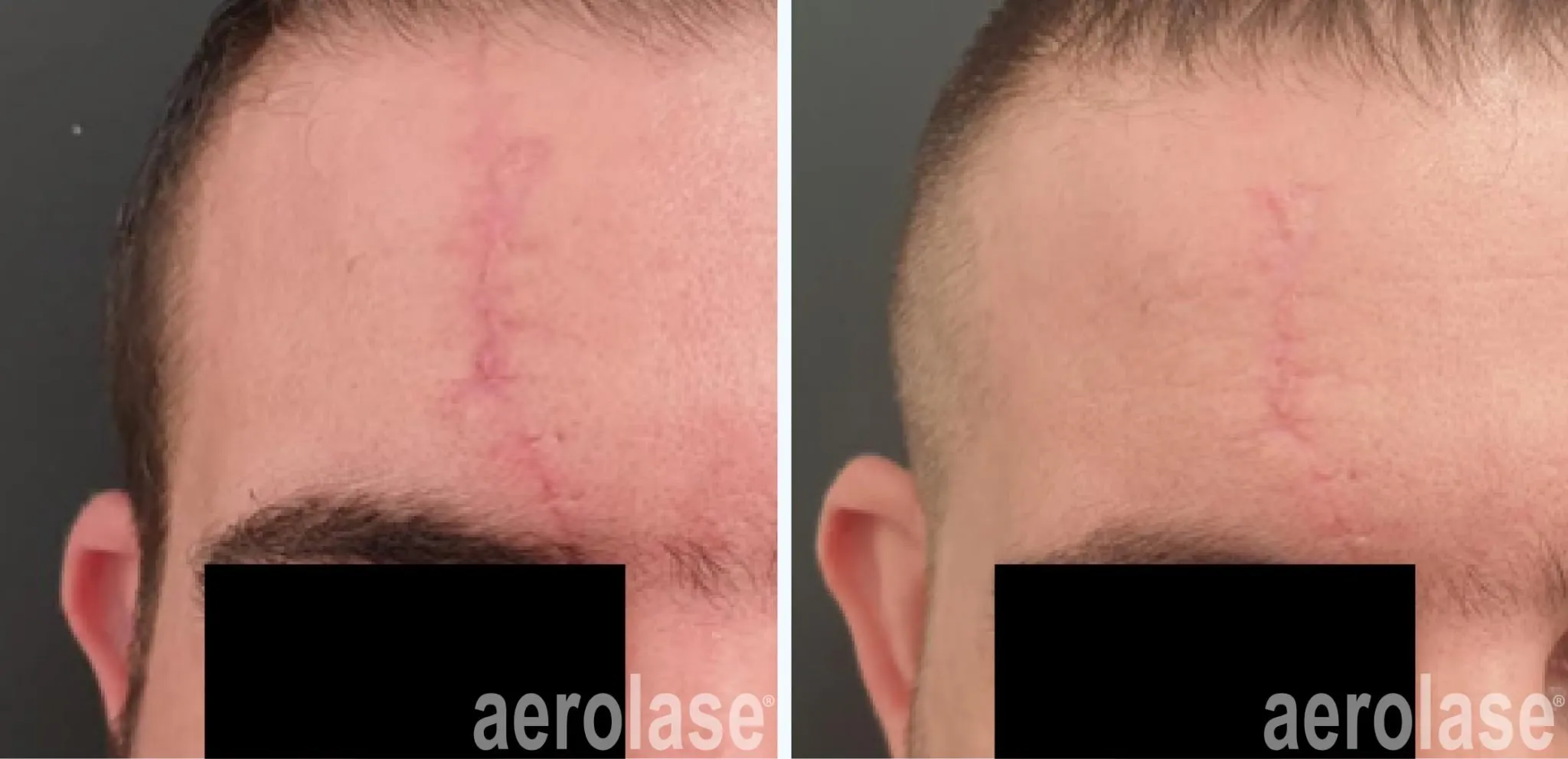 111traumatic-scar-revision-watfa-before-and-after-2048x991