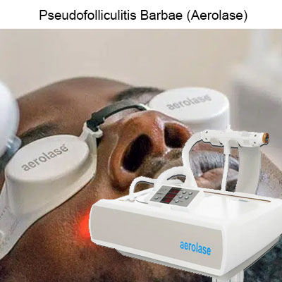 Aerolase-Pseudofolliculitis-Barbae