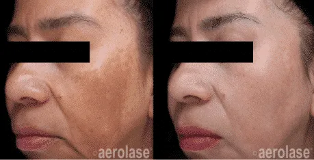 Courtesy-of-Jason-Emer-MD pigmented lesions