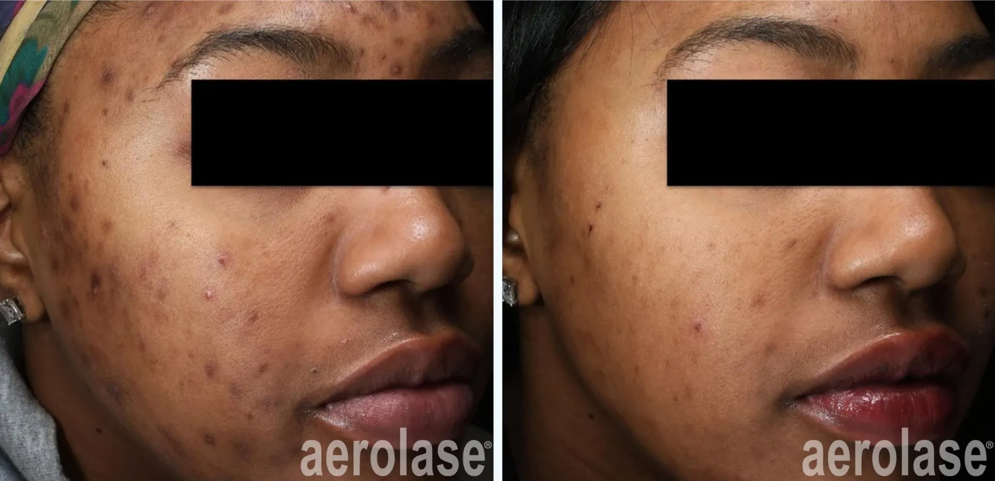 acne-and-pih-treatment-aerolase-nazanin-saedi-before-and-after