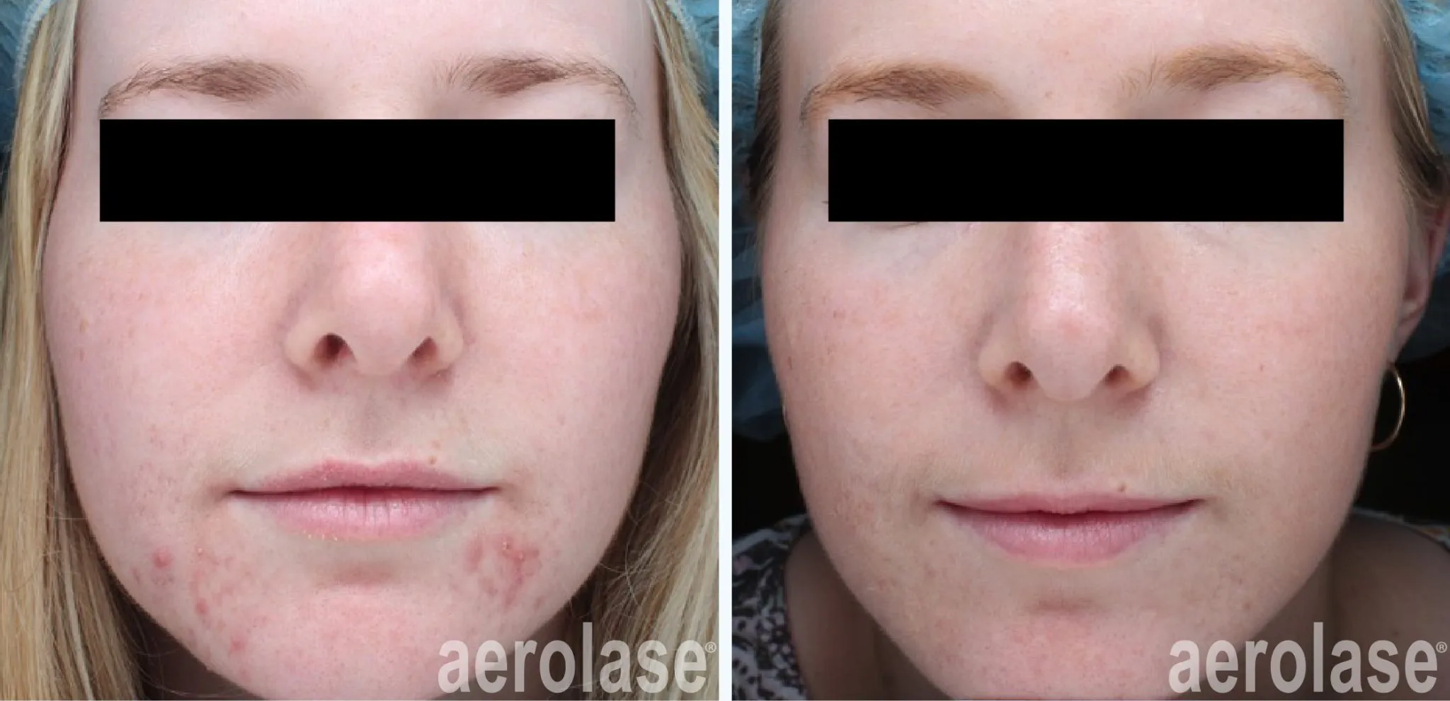 acne-arisa-ortiz-before-and-after