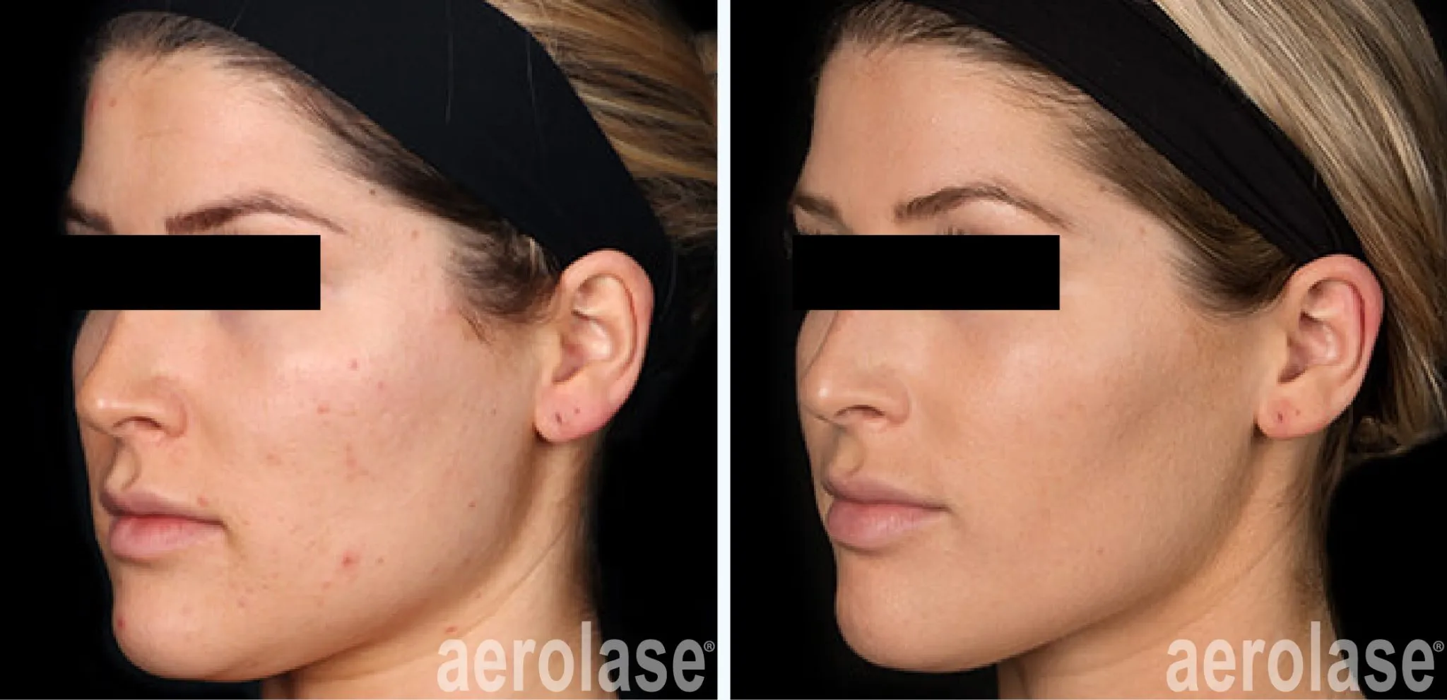 acne-cheeks-jason-emer-before-and-after