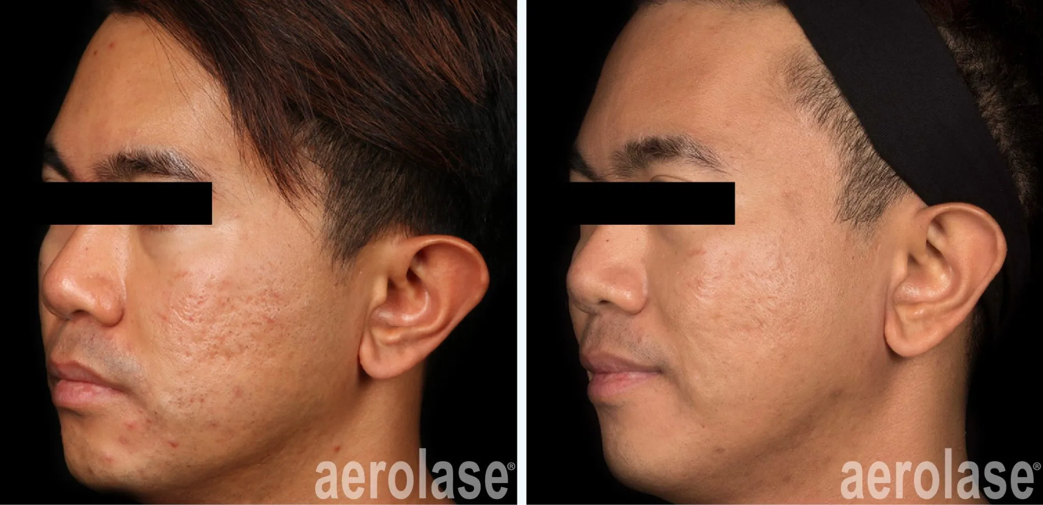 acne-cheeks-soc-jason-emer-before-and-after