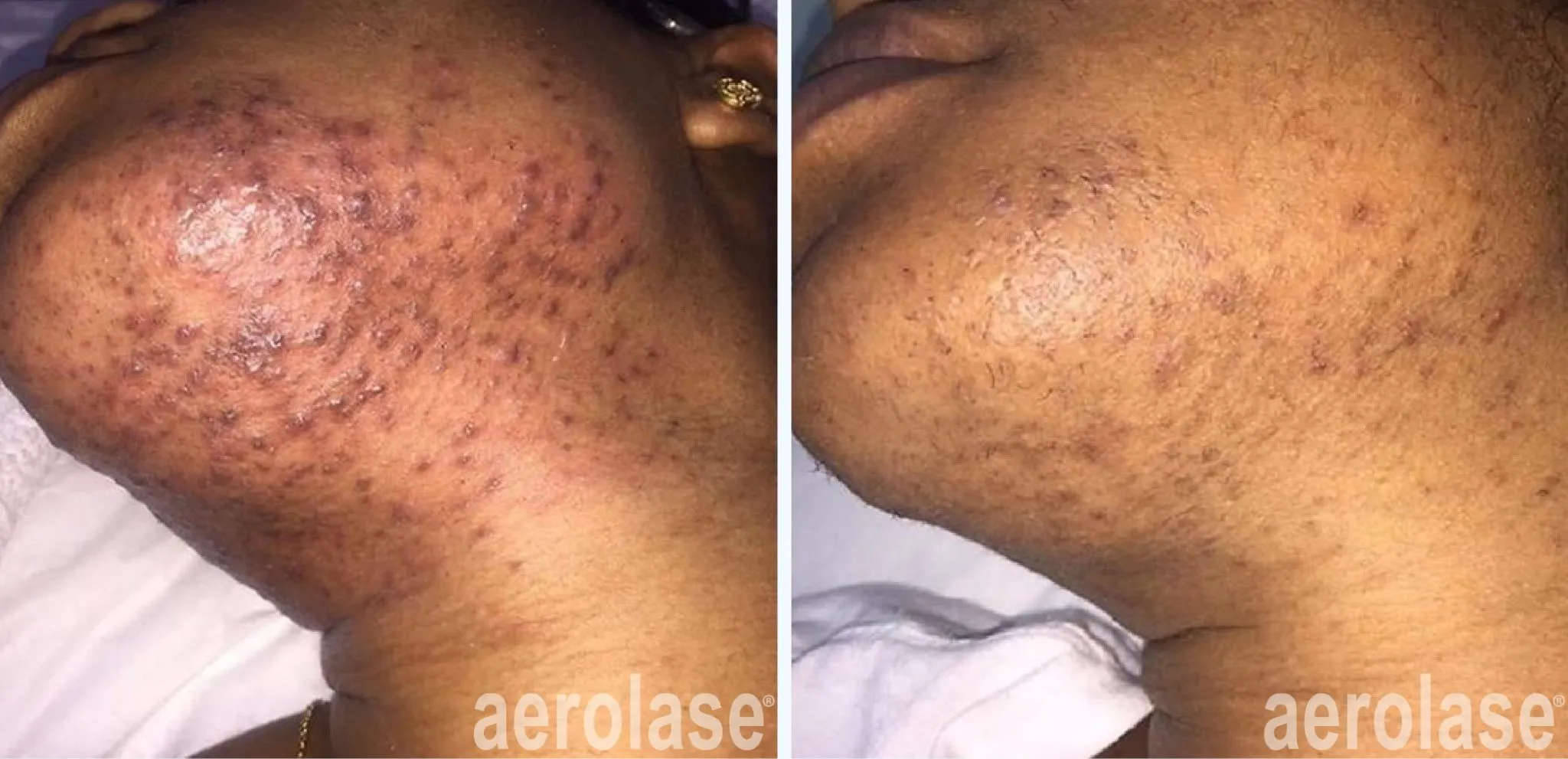 acne-chin-before-and-after