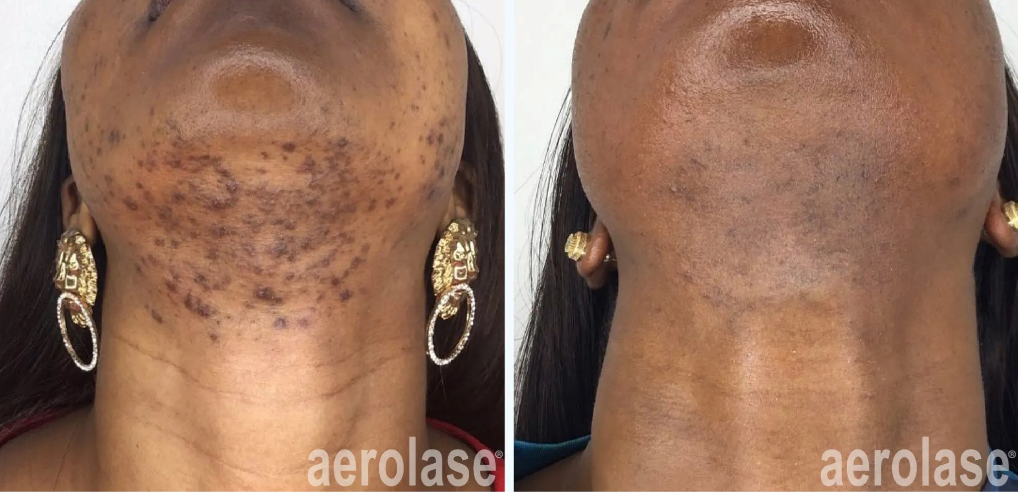 acne-chin-sholema-skinofcolor-before-and-after