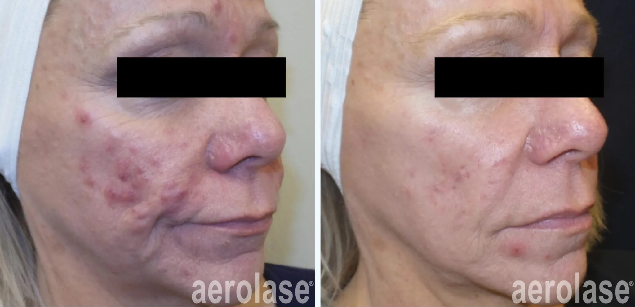 acne-cystic-pinski-before-and-after