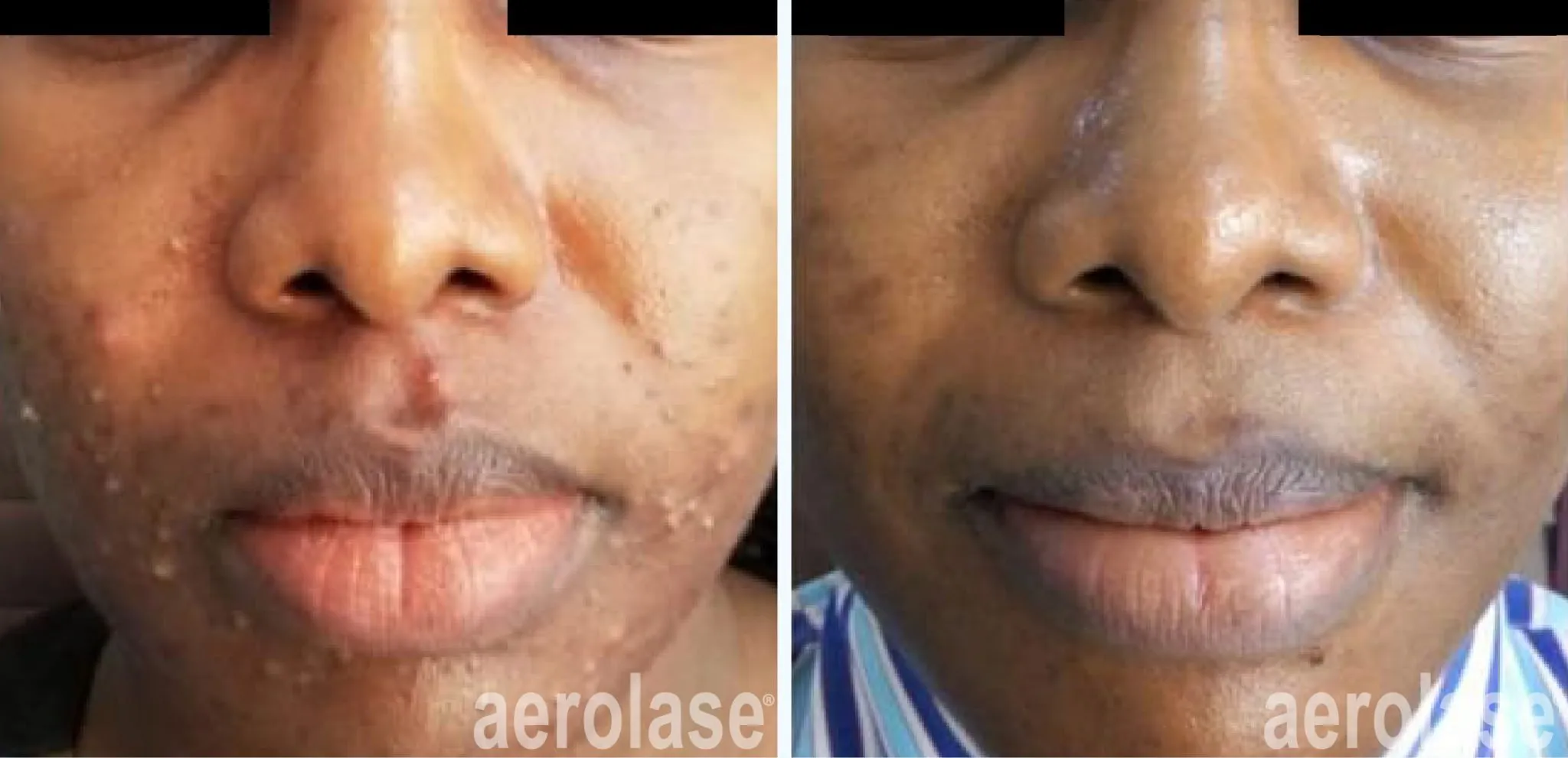 acne-lower-cheeks-sholema-before-and-after-4