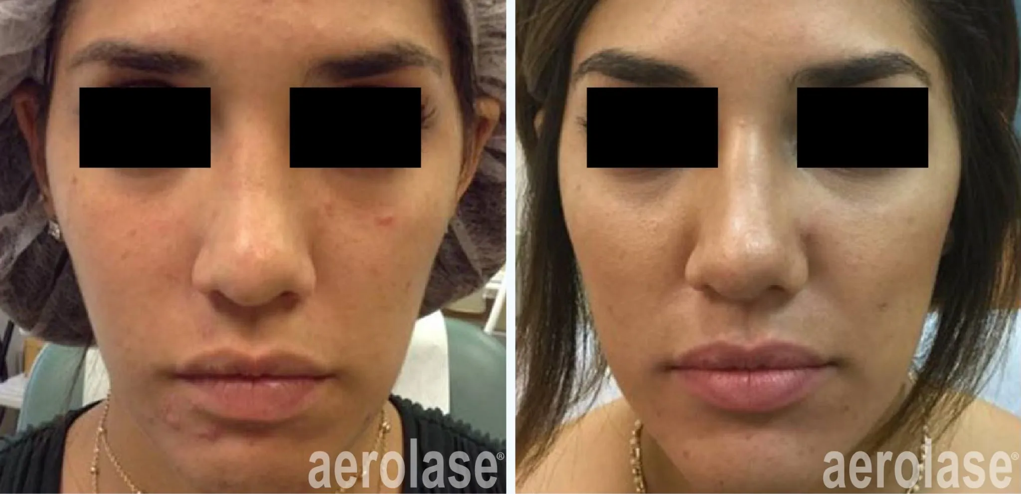 acne-mark-nestor-before-and-after