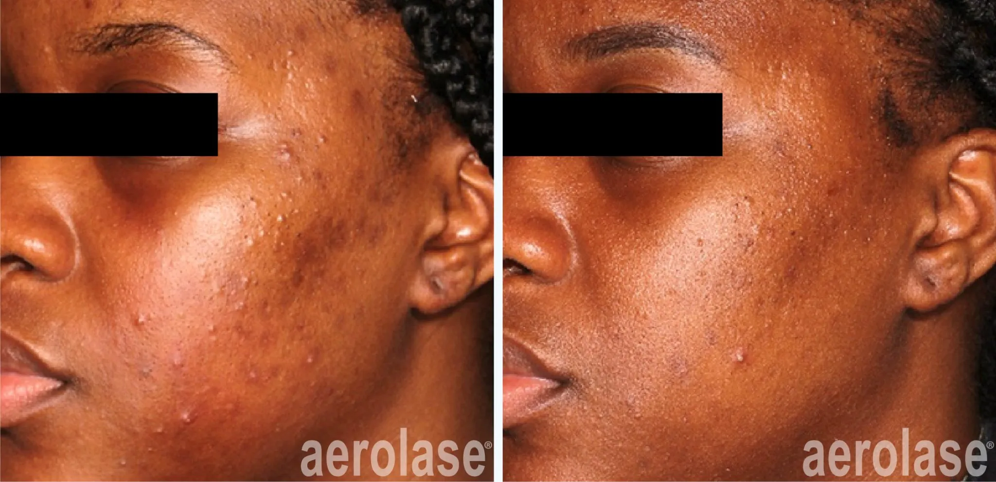 acne-michelle-henry-before-and-after