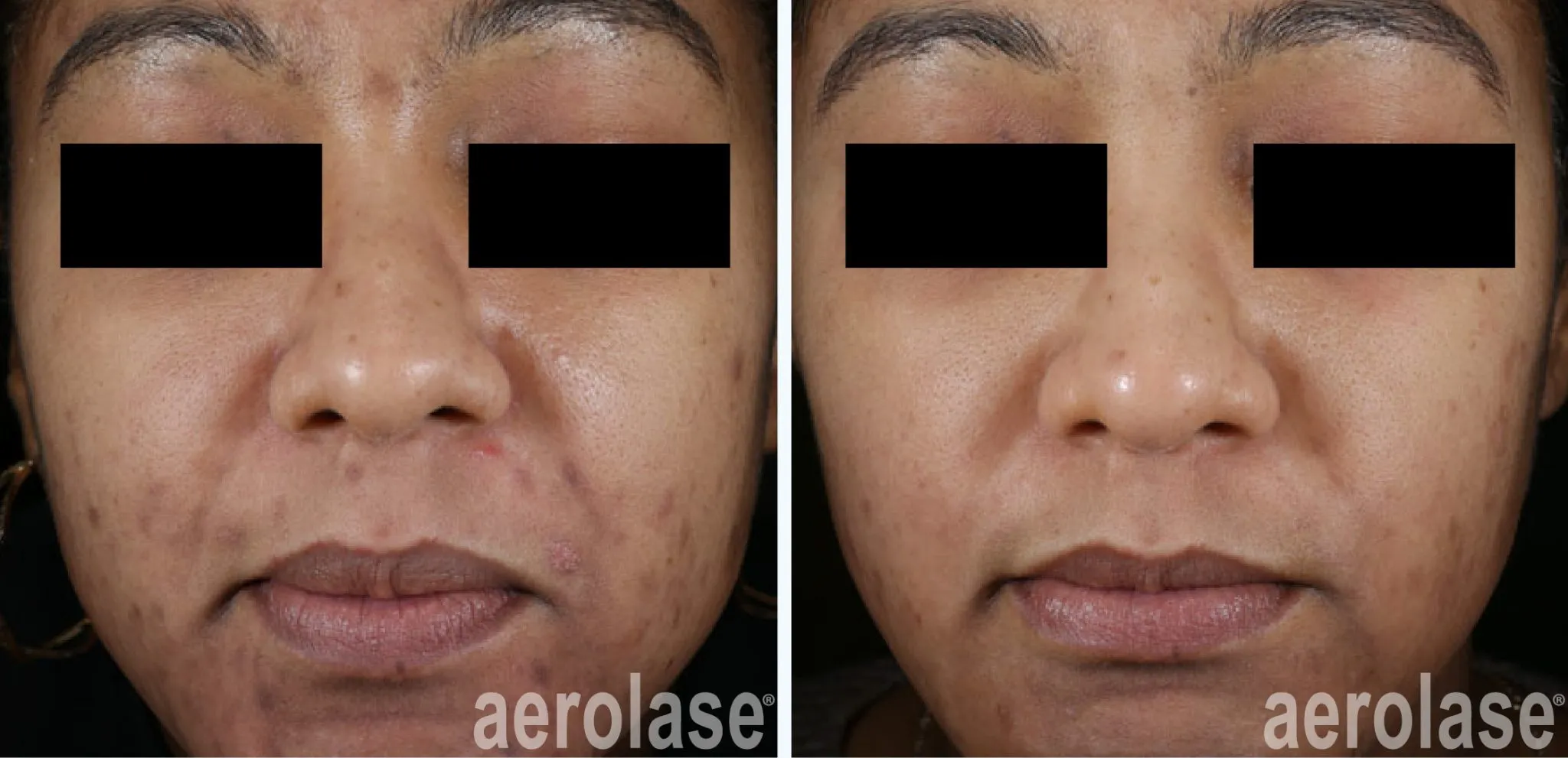 acne-soc-david-goldberg-before-and-after