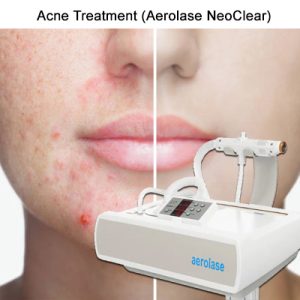 Aerolase Laser: A New Dawn in Acne and Scar Treatment