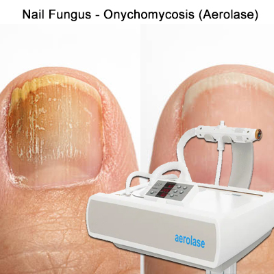 aerolase-nail-fungus-removal